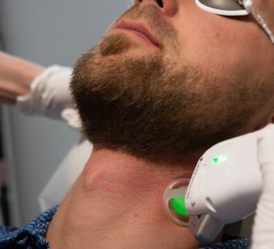 laser hair removal for men calgary
