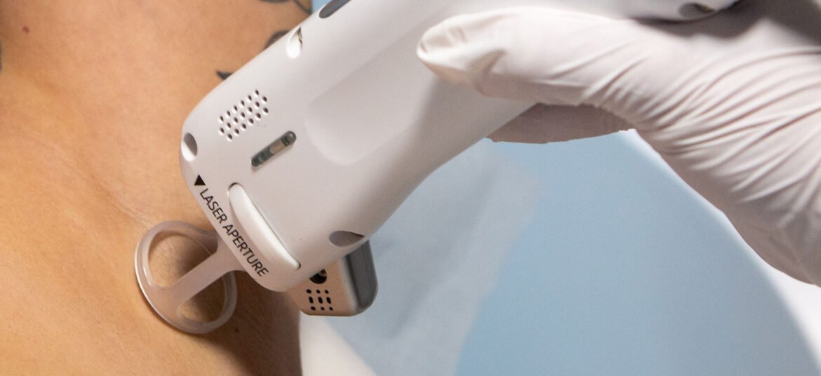 cherry angioma removal calgary