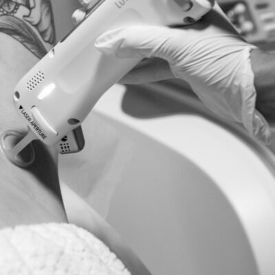 cherry angioma removal calgary