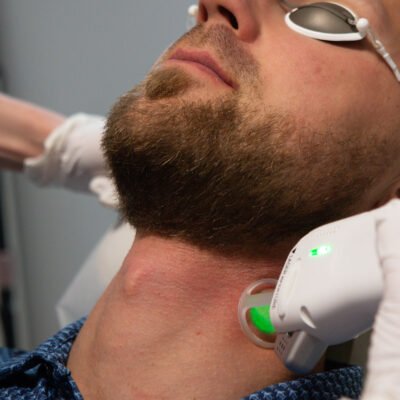 laser hair removal for men calgary