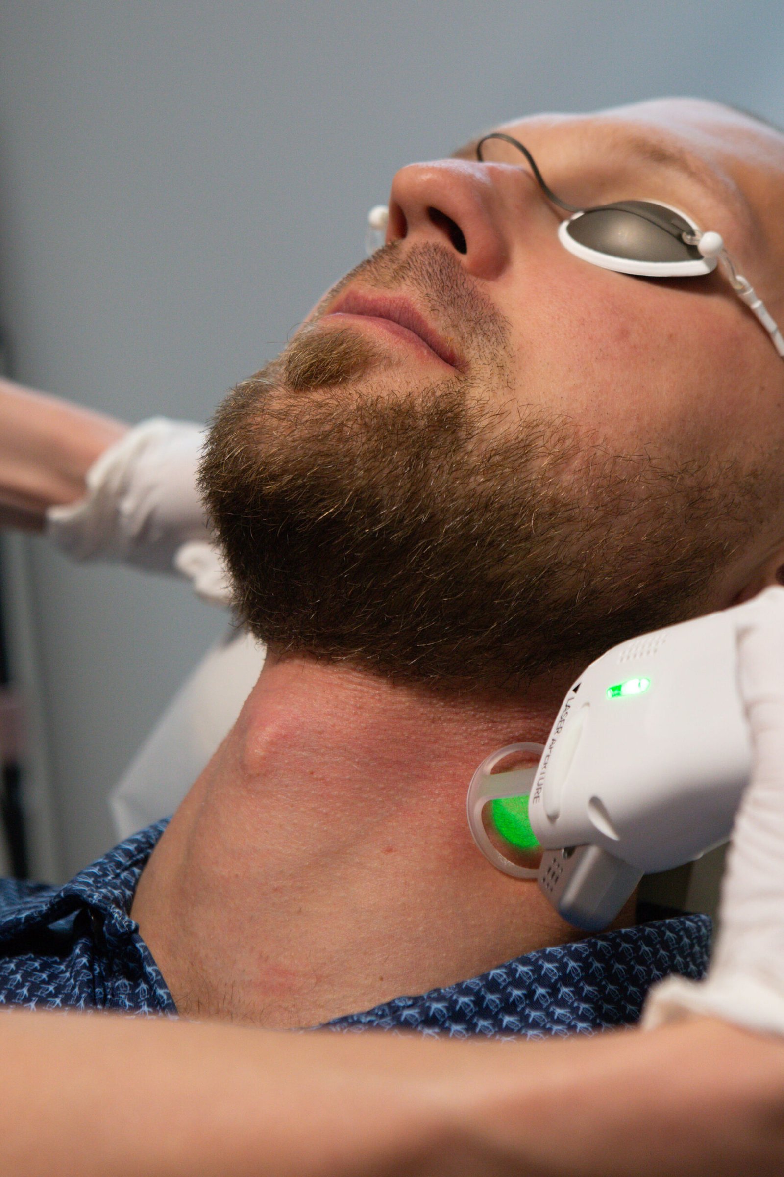 laser hair removal for men calgary