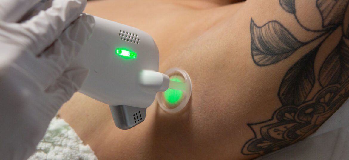laser hair removal cost calgary