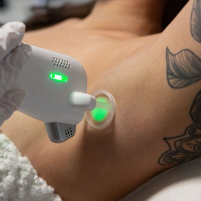 laser hair removal cost calgary